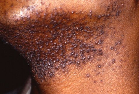 Read more about the article Understanding Razor Bumps: Causes, Treatment, and Prevention